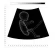 ultrasound, fetus, embryo
