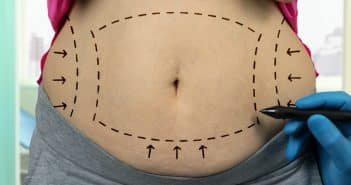 Abdominoplastie et ses effets sur le corps humain
